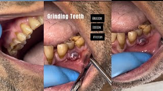 GRINDING TEETH  AbrasionErosion Attrition [upl. by Ylrac]