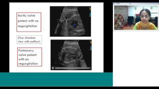 Fetal echo part 3 by Dr Sejal Shah [upl. by Charpentier]