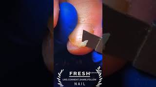 ingrown fungal infection nailfungal ingrown ingrowntoenailsurgery viralvideo foryou [upl. by Bakerman]