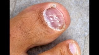 Toenail Fungus Treatment  Home Remedies For Toenail Fungus Know to Work Quickly [upl. by Yelhs]