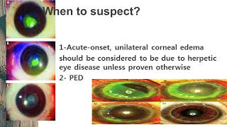 Herpetic keratitis [upl. by Moyers]