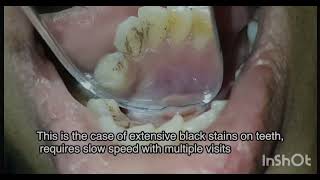 Dental scaling and Polishing [upl. by Hallock559]