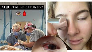 STRABISMUS SURGERY vlog [upl. by Mccallion434]