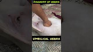 Umbilical hernia l dr umar khan [upl. by Nas]