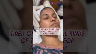 Best ACNE scar Treatment at Richardsons Face Hospitals  Bangalore by Dermatologist [upl. by Atsocal]