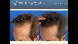 Restoring A Hairline in 1 Hair Transplant Procedure [upl. by Pratte]