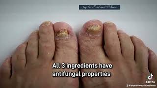 Natural Remedy for Fungus Nail Infection [upl. by Collis]