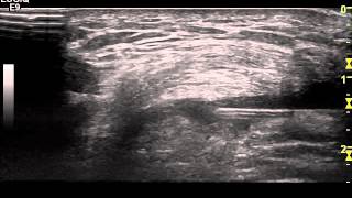 Ultrasound guided Injection of the Suprapatellar pouch Knee Dr Peter Resteghini [upl. by Notsehc]