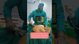 So much fat removed with liposuction in Pune [upl. by Eenel]