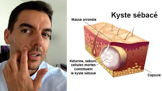 Kyste Sébacé  Mon Expérience  Causes Infection Traitement Opération [upl. by Nylazor]