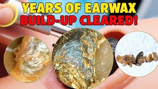 Earwax Removal  Deep Earwax Removal  ASMR  Earwax Removal Video [upl. by Leidba943]