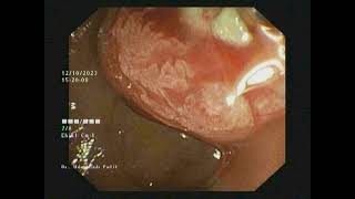 Pancreatic Duct PD Dilatation [upl. by Gonta]