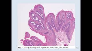 Oral Epithelial Tumors  Benign [upl. by Britt]