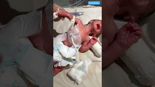 Premature baby video newbornbaby viralvideo [upl. by Arebma917]