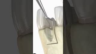 Dental Bone Graft 3D Animationshorts [upl. by Arotahs]