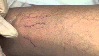 Spider Vein Sclerotherapy [upl. by Cuda796]