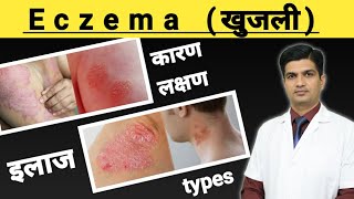 Eczema Treatment  Eczema kya hota hai [upl. by Sivra]