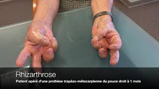 Main  Rhizarthrose ou Arthrose du pouce [upl. by Lashoh]