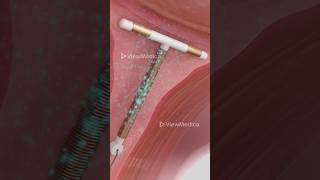 How does a copper IUD work 3D Animation [upl. by Even]