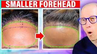 How To Fix a Large Forehead Forehead Reduction [upl. by Hanikahs653]