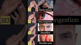 Febrile diseaseeyes congestion jaundice shoulder pain trending 2million biology shortsfeed [upl. by Anelej]