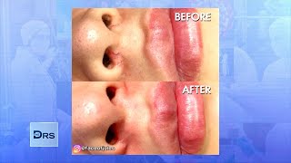 Broken Capillaries on Face See Before amp After Removal Treatment [upl. by Turtle]