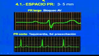 INTERPRETACION DEL ELECTROCARDIOGRAMA [upl. by Higgins]