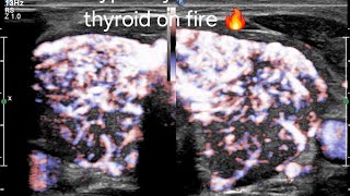 How to Differentiate Hashimotos Thyroiditis vs Hyperthyroidism on Ultrasound amp Doppler ultrasound [upl. by Ilac583]