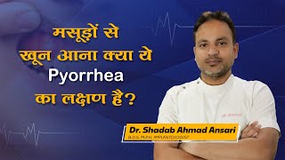 मसूड़ों से खून आना क्या ये Pyorrhea का लक्षण है cavities dentist medical knowledge [upl. by Niarda360]