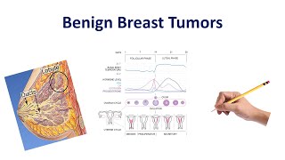 Benign Breast Conditions  USMLE COMLEX NCLEX [upl. by Einreb]