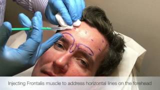 Injecting Frontalis muscle [upl. by Fink]