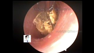 Ear Wax Removal Cerumen Cleaning Collection20220618 [upl. by Vipul]