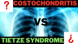 Tietze Syndrome OR Costochondritis [upl. by Etnom427]