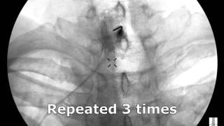 Cervical Interlaminar Epidural Steroid Injection  ThePainSourcecom [upl. by Midge]