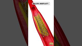 Balloon angioplasty  angioplasty  central vein balloon angioplasty  Angioplasty animation [upl. by Geraint677]