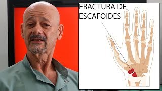 Fractura del hueso escafoides de la muñeca [upl. by Heti]