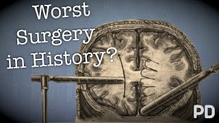 The Dark side of Science The Lobotomy the worst surgery in history Documentary [upl. by Milli]