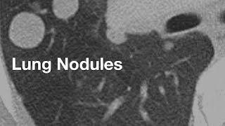 Lung Nodules basics for patients [upl. by Adriaens]