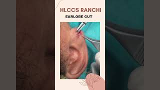 Hlccs Ranchi Earlobe Cut Laser Treatment Call now 9334334935 9431529553 [upl. by Secunda]