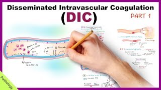 DIC Disseminated Intravascular Coagulation  Part 1 [upl. by Aivatra]