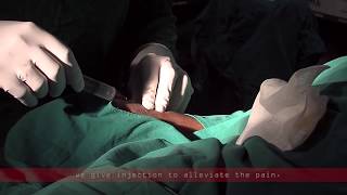 Coronary angiogram  a live demonstration [upl. by Sianna]