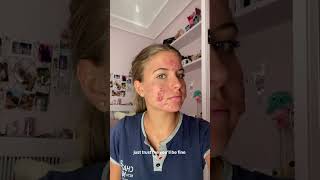 ACNE  UNE FEMME GUERIT DE SON ACNE APRES TRAITEMENT acne acnetreatment santé boutons femme [upl. by Ayn]