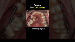 Braces for cleft palate progess braces orthodontist dentist dentistry [upl. by Ellesirg]