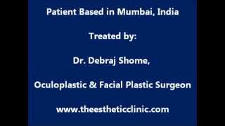 Blepharospasm amp Hemifacial Spasm Eye Twitching Treated with Botox Injection [upl. by Ahserak]