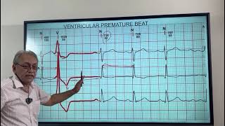 VENTRICULAR ECTOPICS  VENTRICULAR PREMATURE BEATS HOW TO DIAGNOSE ON ECG [upl. by Flyn]