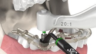 Dental Implantology  Guided Surgery Animation SICace implant insertion [upl. by Alyel589]