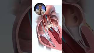 Incredible Aortic TAVI Animation Visual Explanation of Heart Procedure [upl. by Aenat]