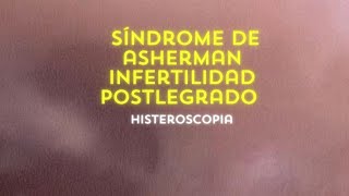 Síndrome de Asherman  Infertilidad Post legrado Histeroscopia [upl. by Araem]