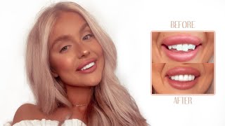 TEETH TRANSFORMATION VLOG  Composite Veneers Cost Procedure  all you need to know ✨ [upl. by Adnovad]