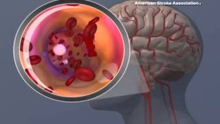 Ischemic Stroke Animation [upl. by Umberto]